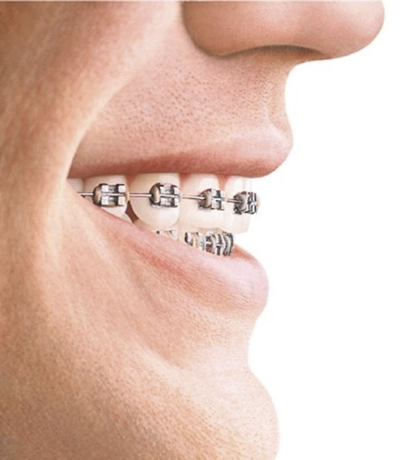 ortodoncia e higiene bucal