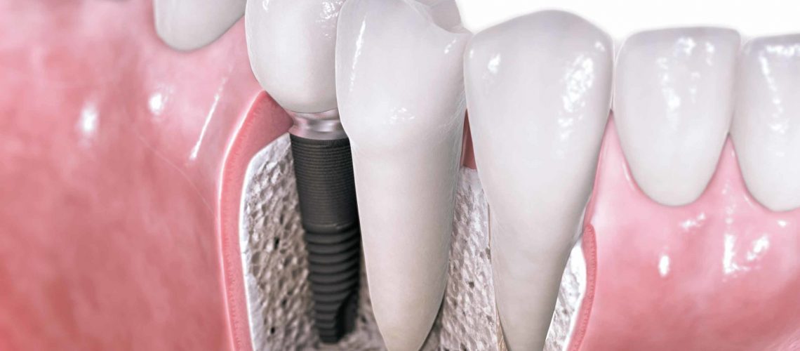 Implantes-dentales-con-cirugia