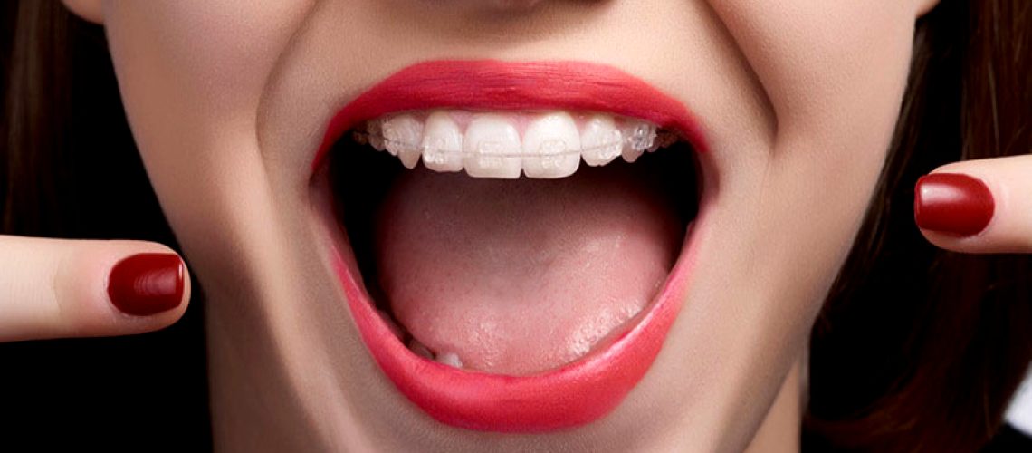 aparatos-en-los-dientes