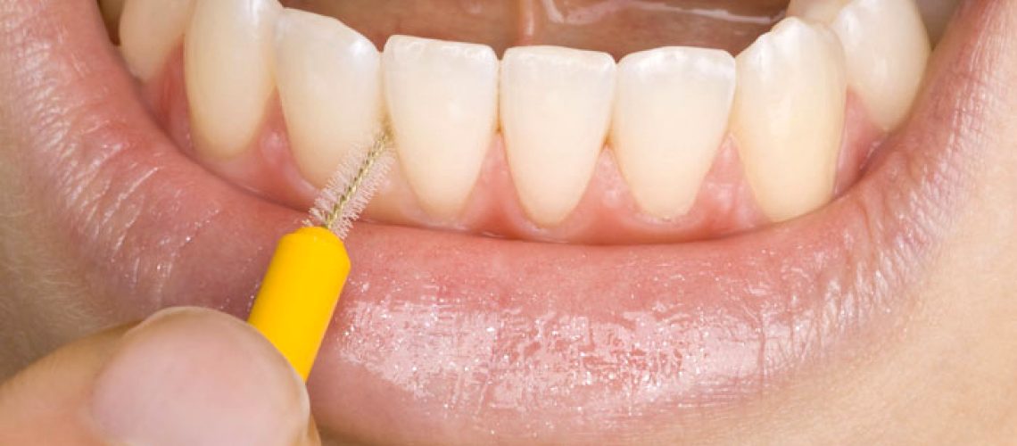 limpieza-de-protesis-dentales