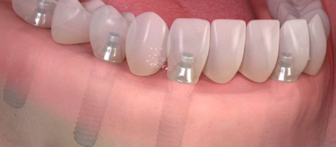 Tipos de prótesis dentales